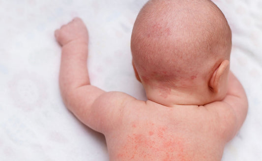 National Eczema Week: Helping you to soothe your children’s skin - Childs Farm